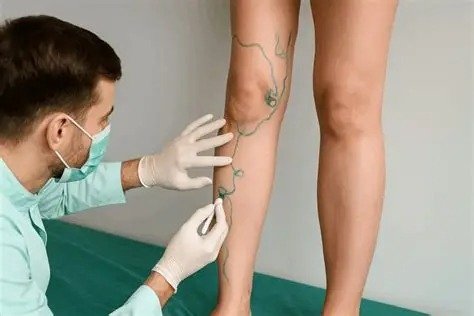 Varizes calibrosas podem aumentar risco de complicações e exigem avaliação individualizada, alerta especialista