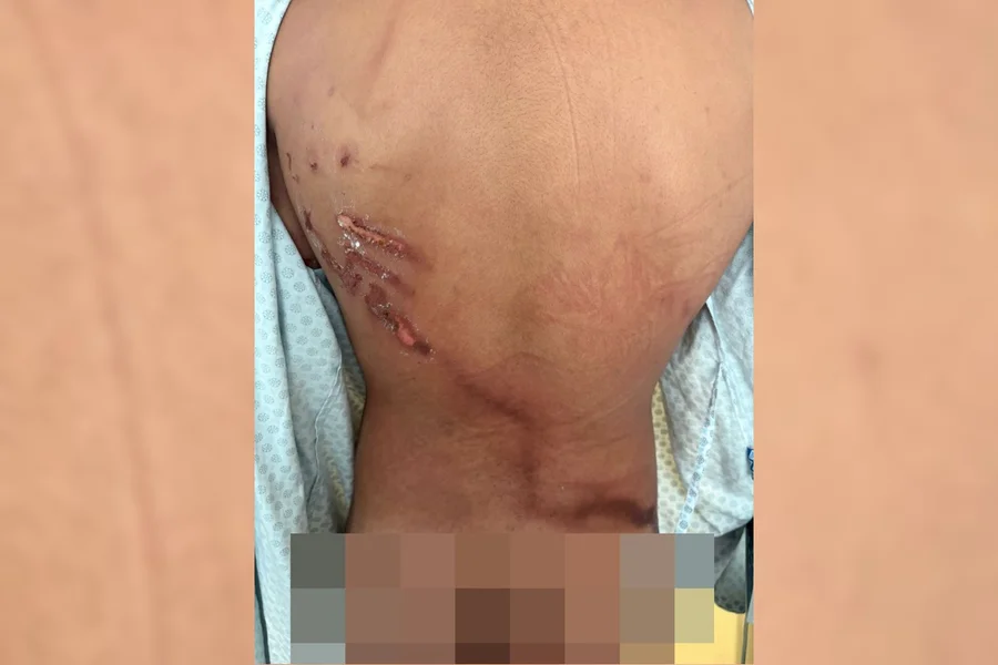 Jovem que teve costas rasgadas por raio em ato de Nikolas: “Achei que tinha 1h de vida”