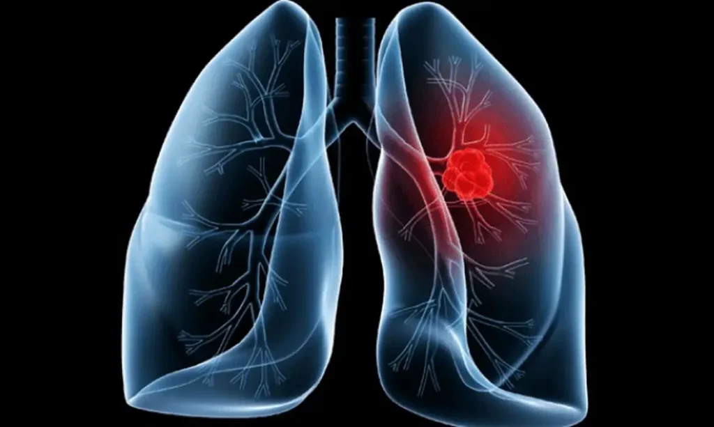 Saiba o que é adenocarcinoma pulmonar, câncer que atinge o papa